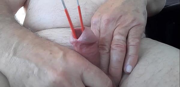  Tweezers in urethra stretching.